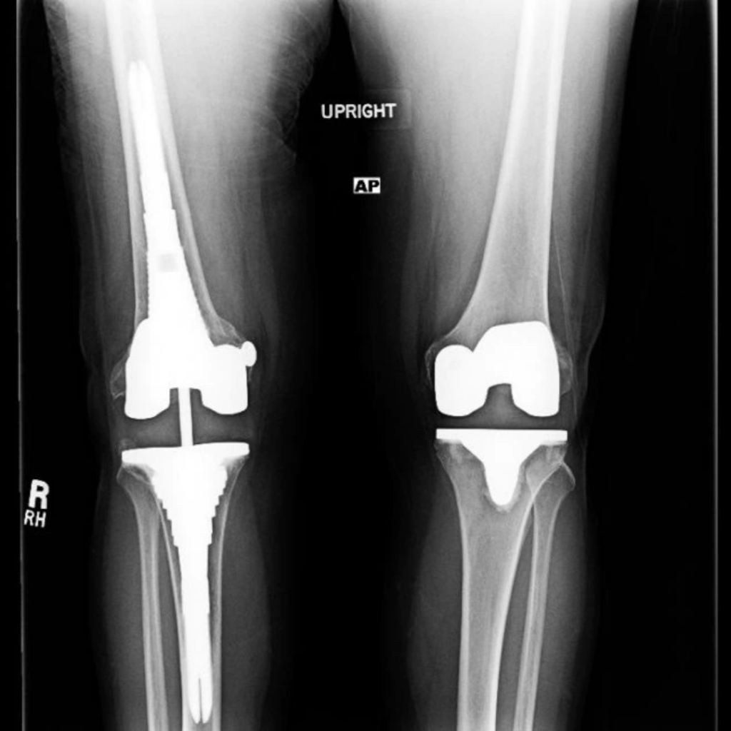 JOINT PRESERVING SURGERY / REPLACEMENTimage