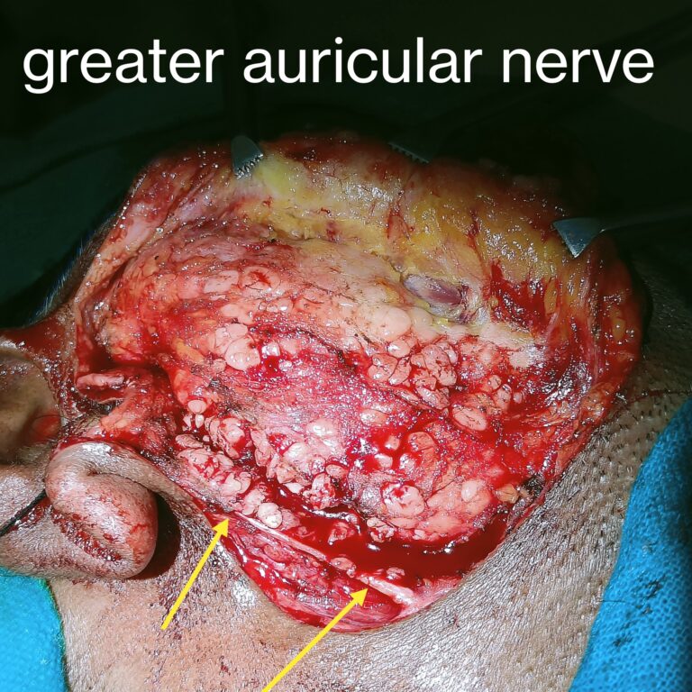 Superficial parotidectomy surgery for  pleomorphic adenoma parotid