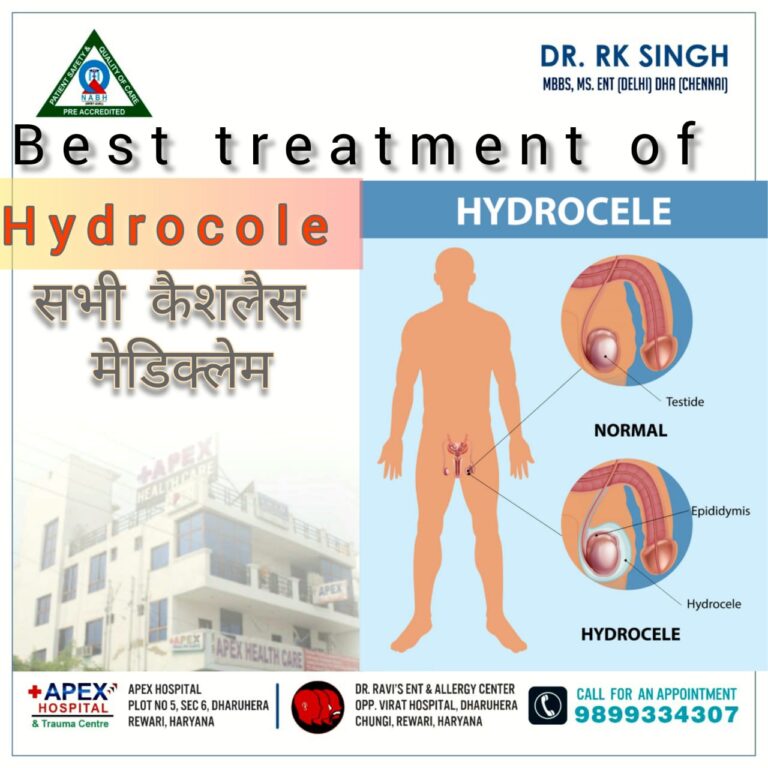 हाइड्रोसील के कारण , उपचार , उपाय , लक्षण और बचाव