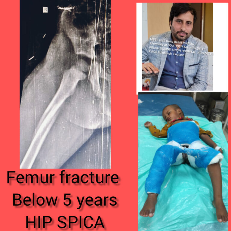 Thigh bone fracture in children less than 6 years